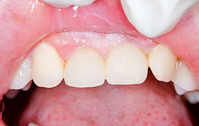 Custom dentures - after