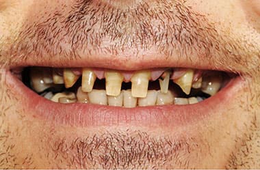 Full smile restoration - before